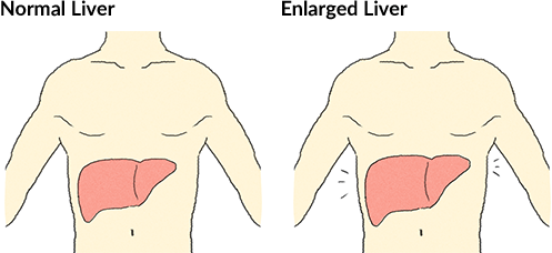 Normal Liver Enlarged Liver