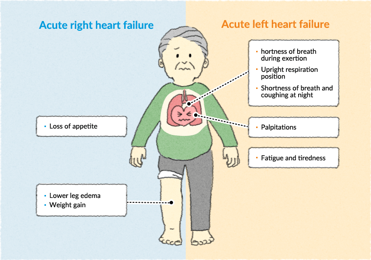 Acute right sided heart failure