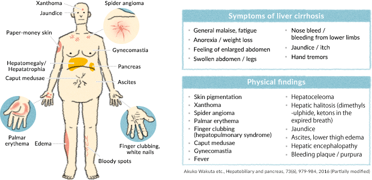 liver cirrhosis symptoms