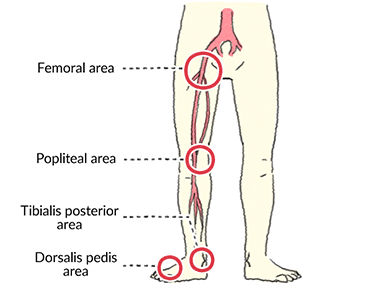 Peripheral Pulses