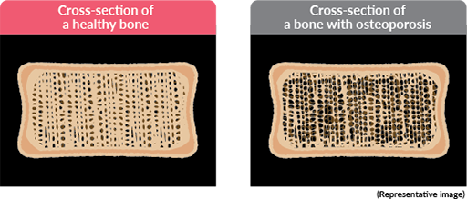 Cross-section of a healthy bone / Cross-section of a bone with osteoporosis