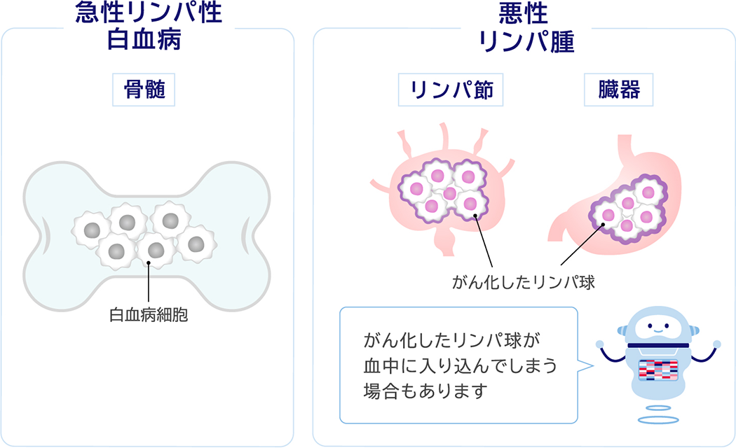 急性リンパ性白血病 骨髄 白血病細胞 悪性リンパ腫 リンパ節 臓器 がん化したリンパ球 がん化したリンパ球が血中に入り込んでしまう場合もあります