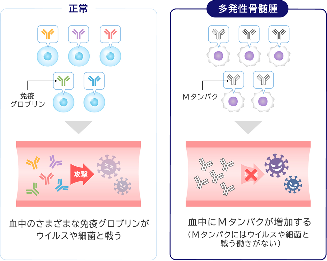 正常 血中のさまざまな免疫グロブリンがウイルスや細菌と戦う 多発性骨髄腫 血中にMタンパクが増加する（Mタンパクにはウイルスや細菌と戦う働きがない）