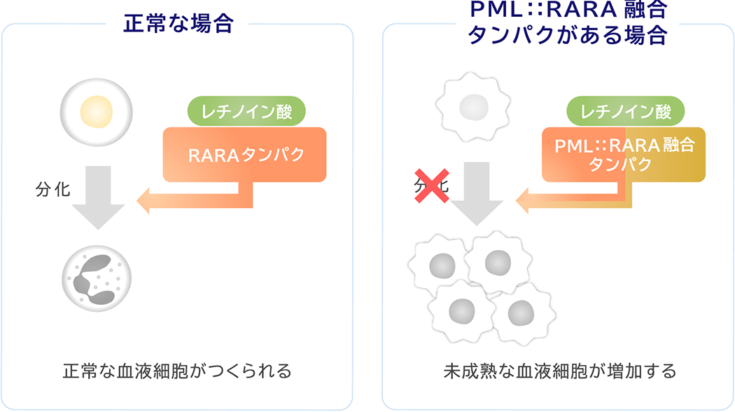 正常な場合 正常な血液細胞がつくられる PML::RARA融合タンパクがある場合 未成熟な血液細胞が増加する