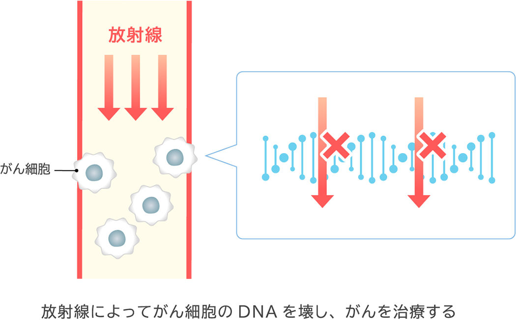 放射線によってがん細胞のDNAを壊し、がんを治療する