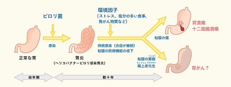 ピロリ 菌 症状