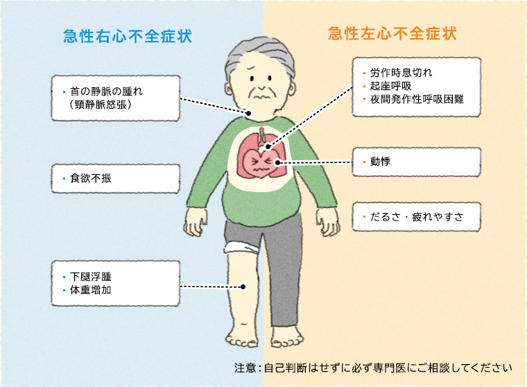 急性右心不全症状 首の静脈の腫れ（頸静脈怒張） 食欲不振 下腿浮腫 体重増加 急性左心不全症状 労作時息切れ 起座呼吸 夜間発作性呼吸困難 動悸 だるさ・疲れやすさ 注意：自己判断はせずに必ず専門医にご相談してください