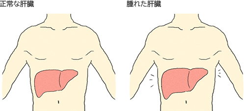 正常な肝臓 腫れた肝臓