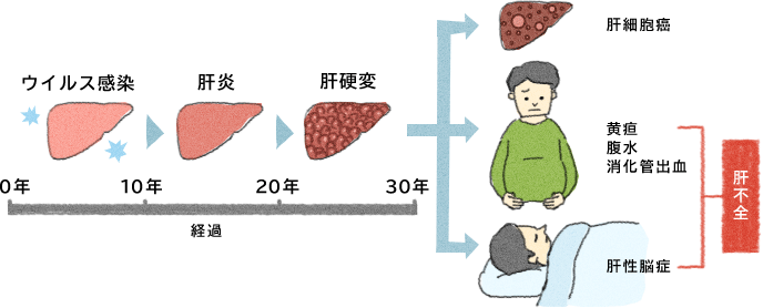 肝硬変 症状 チェック