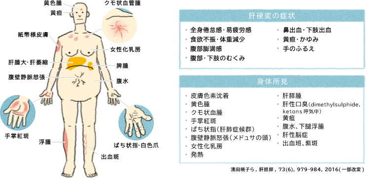 チェック 肝硬変 症状 肝硬変