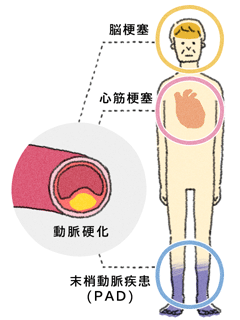 Padはどんな病気 大塚製薬