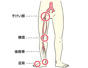 Padの病院での検査方法 大塚製薬