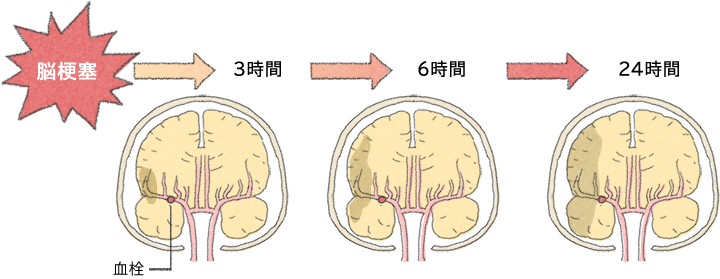 脳卒中の症状は 大塚製薬