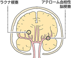 脳梗塞の種類 大塚製薬 脳梗塞の種類 大塚製薬