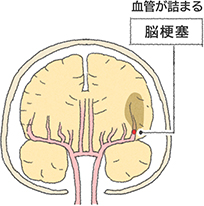 血管が詰まる脳梗塞