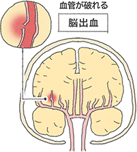 脳卒中の種類は 大塚製薬