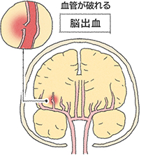 血管が破れる脳出血