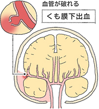 血管が破れるくも膜下出血