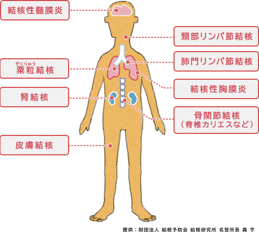 結核 癌 に なり にくい