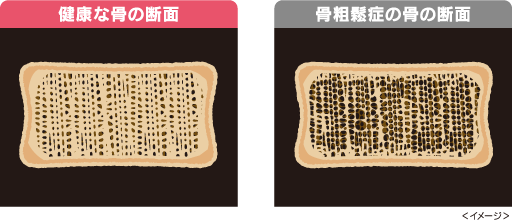 健康な骨の断面／骨粗鬆症の骨の断面