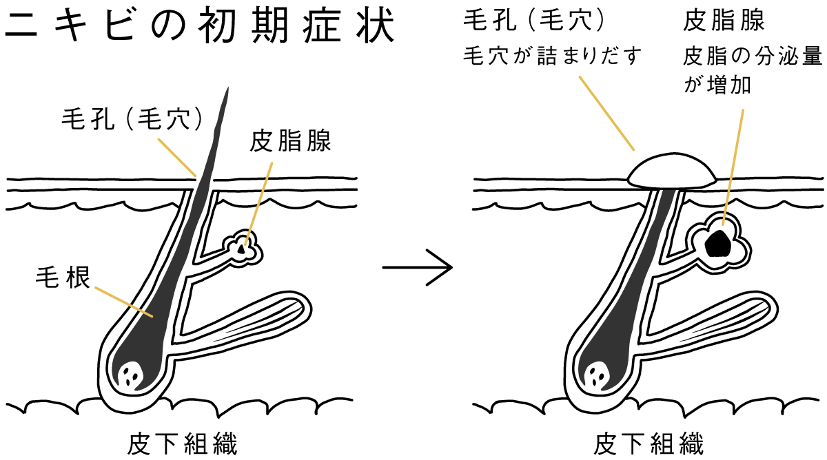 オロナイン ニキビ ワセリン