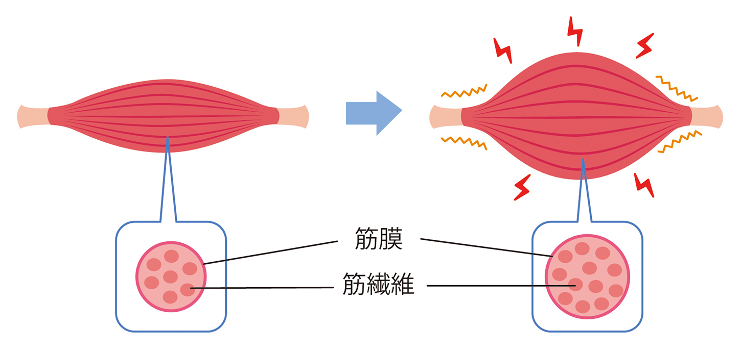 筋肉に痛みが生じるしくみ