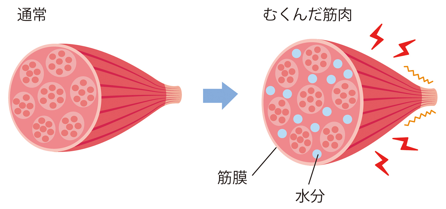 筋肉に水分が集まりむくんでいる様子