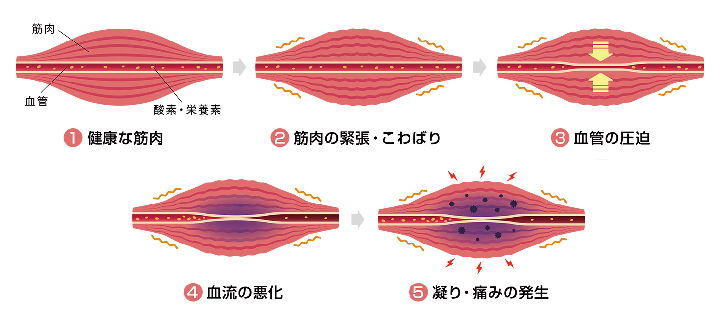 筋膜が硬くなり、肩こりを引き起こしているイメージ