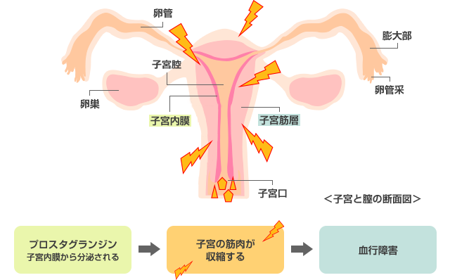 月経痛の原因はプロスタグランジン