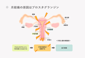 月経痛の原因はプロスタグランジン