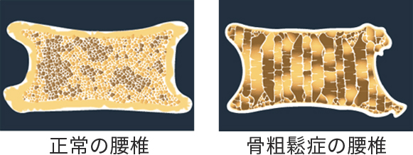 女性の加齢による骨量の変化と骨粗鬆症